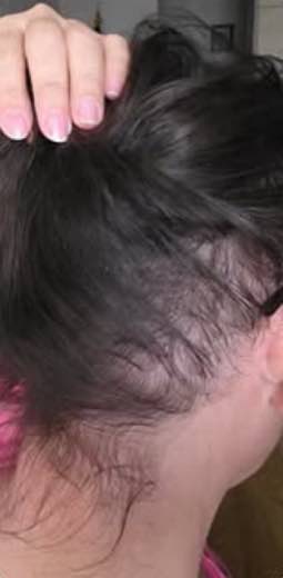 New hair growth at the side after a course of treatments at NASU