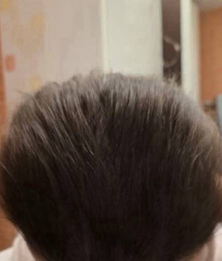 Fuller hair on the crown after 6 months of scalp care at NASU