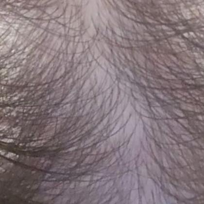 Thinning crown before treatment
