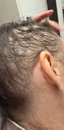 Bald patches at the side of the head before treatment